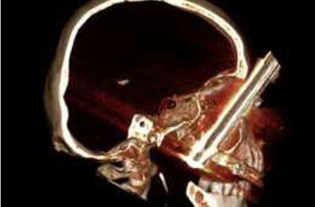 Die CT-Aufnahme zeigt den Kochtopfstiel, der in der Augenhöhle des 64-Jährigen feststeckt.