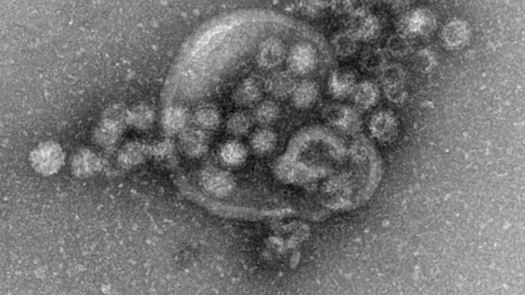 Brechdurchfall durch Norovirus: Fallzahlen steigen derzeit deutlich