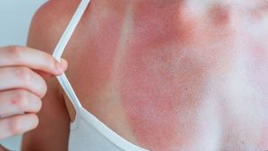 Neben Fieber kann es bei starkem Sonnenbrand auch zu Schüttelfrost kommen. Warum man bei Sonnenbrand friert, erfahren Sie hier.