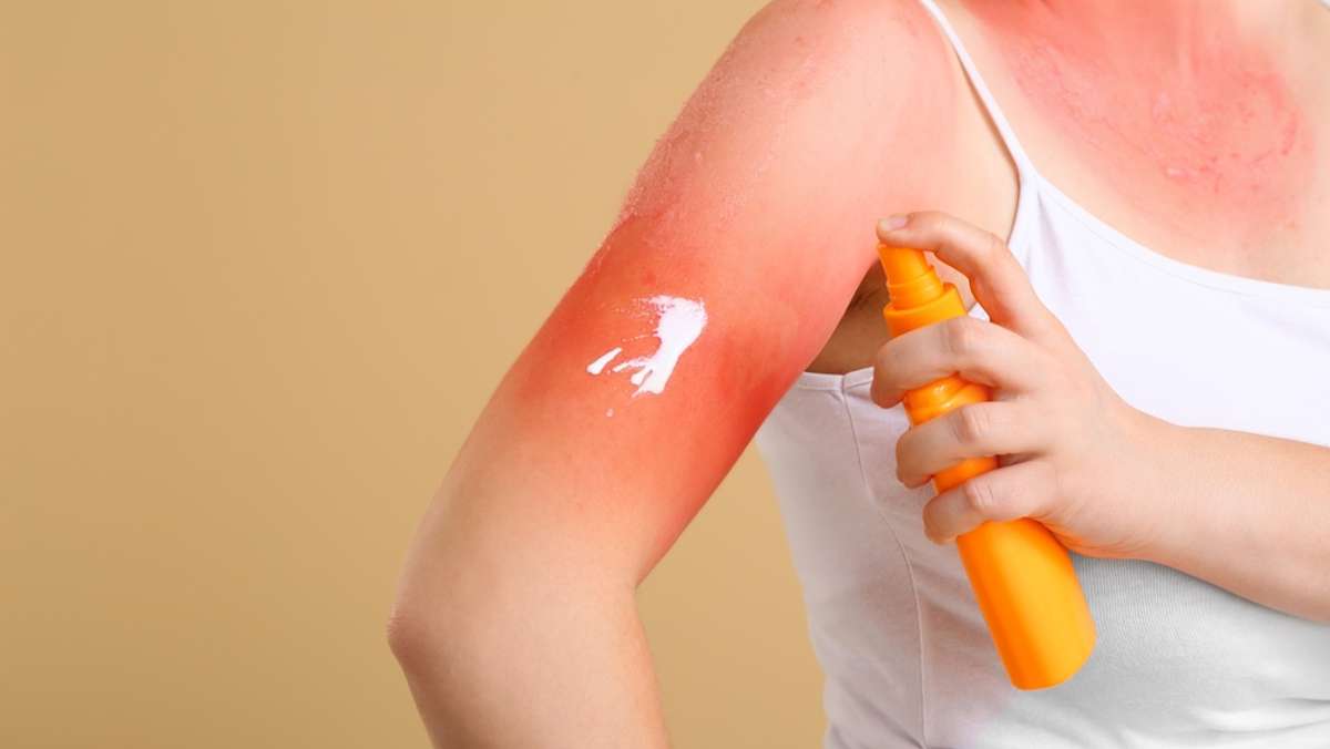 Sonnenbrand trotz Sonnencreme: 7 mögliche Gründe