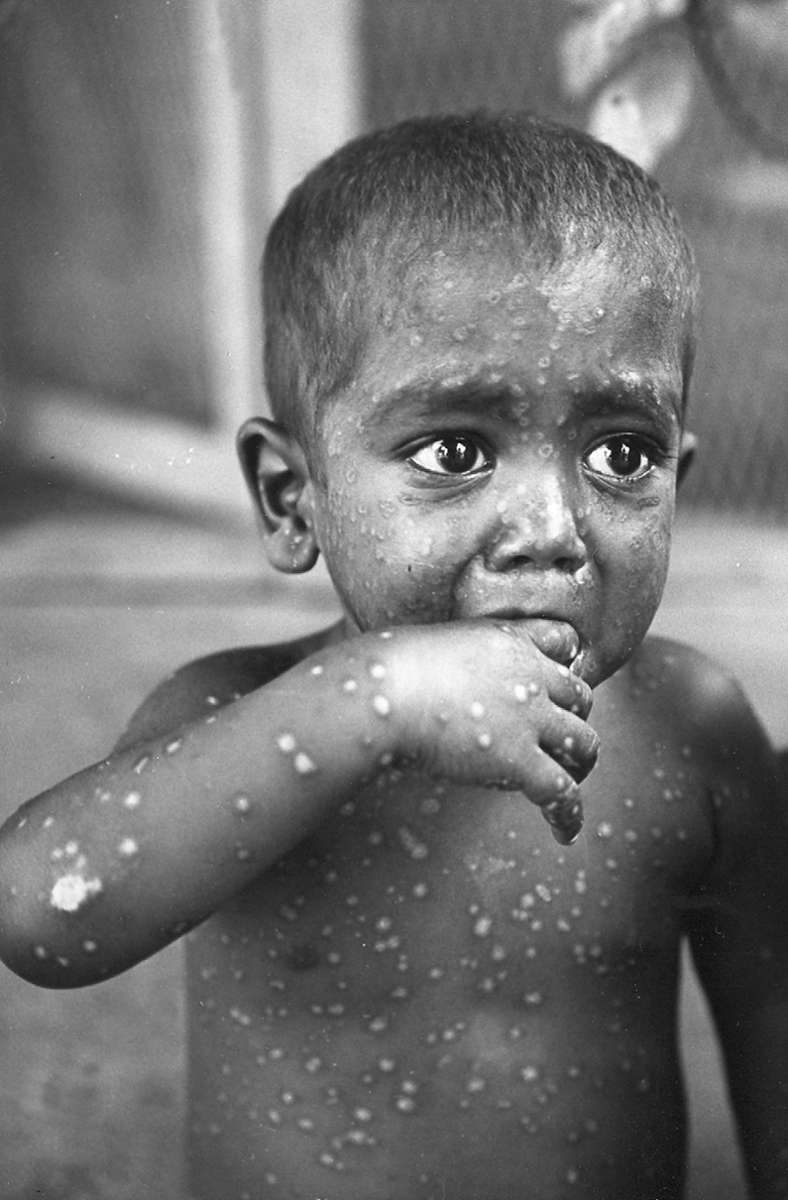 Eine an Pocken erkrankter Junge aus dem indischen Madras in den 70er Jahren.