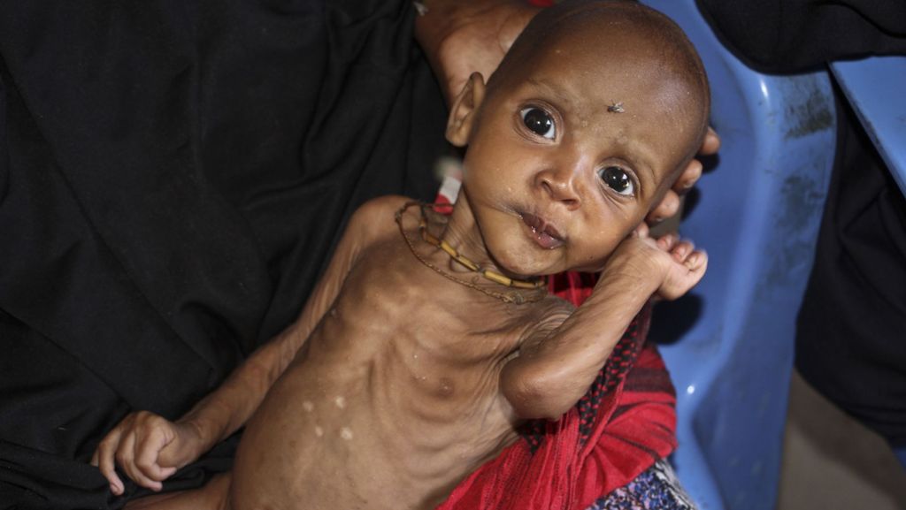 Dürre in Somalia: Zehntausenden Kindern droht der Hungertod