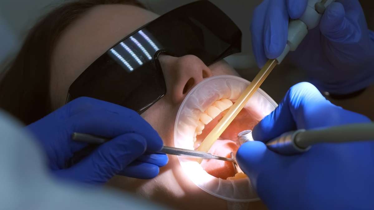 Eine Patientin bei der Präparation von Veneers – Ein Teil des Zahnschmelzes wird abgeschliffen.