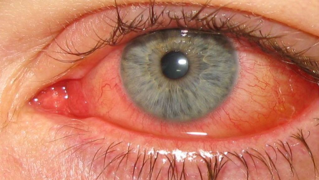 Gesundheit: Schmerzhaft und ansteckend: Augengrippe