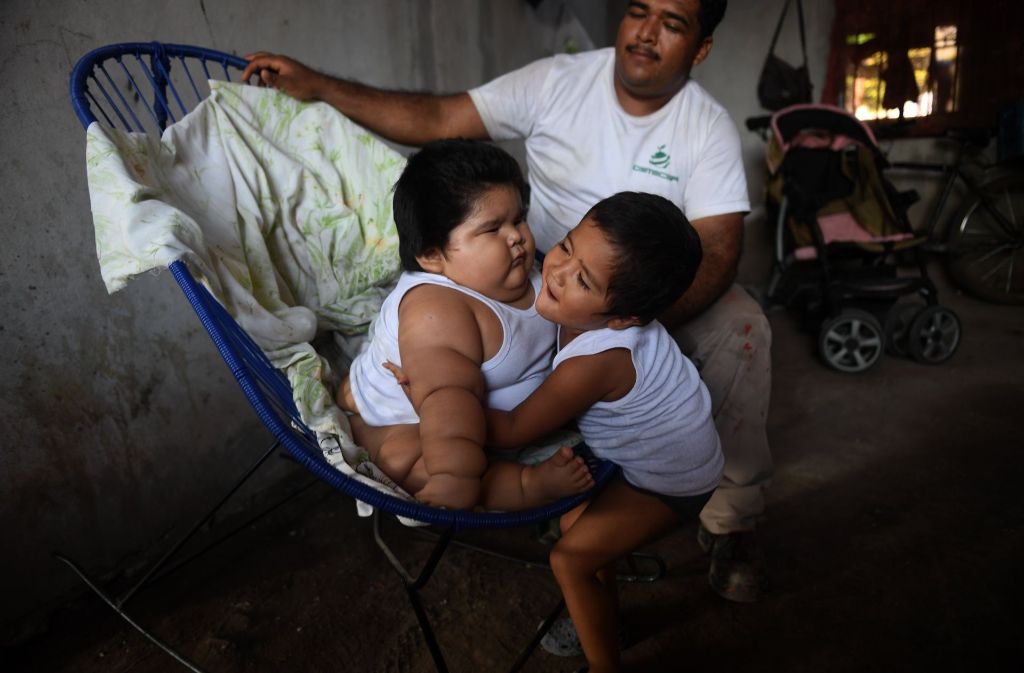 Die Gründe für Luis’ enorme Gewichtszunahme sind unklar. Er befindet sich aber in medizinischer Behandlung einer mexikanischen Ärztin und Ernährungsspezialistin.