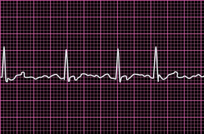 Gefährliche Herzrhythmusstörung: Wenn das Herz ins Flattern kommt