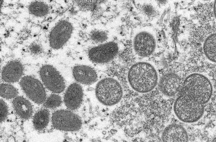 Affenpocken: Erster Fall des Virus in Deutschland bestätigt