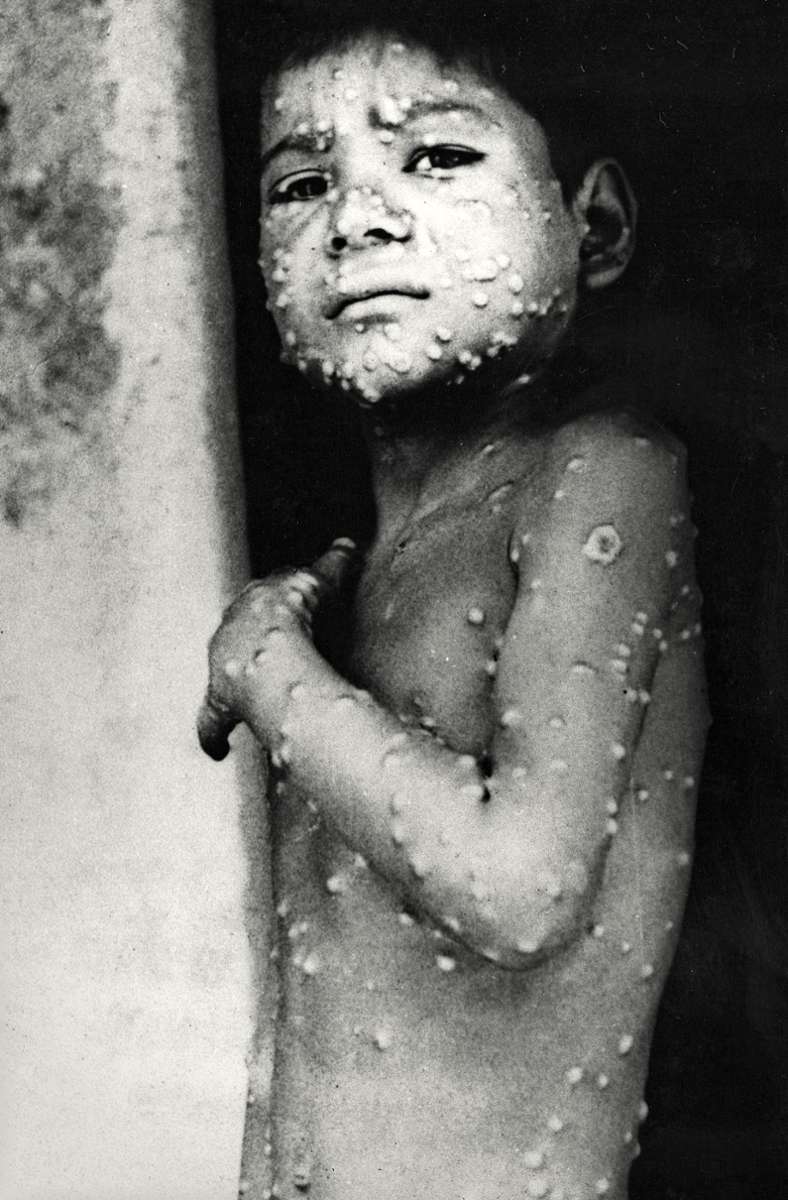 Ein Siebenjähriger mit Pocken 1975 in Indien – erst vier Jahre später wird die Weltgesundheitsorganisation die Krankheit für ausgerottet erklären.