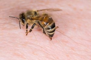 Bienenstachel entfernen