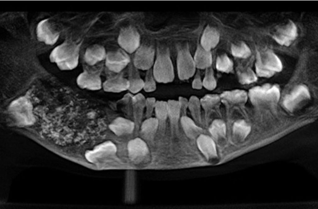 Grau zahn kind wird Zahnunfall beim