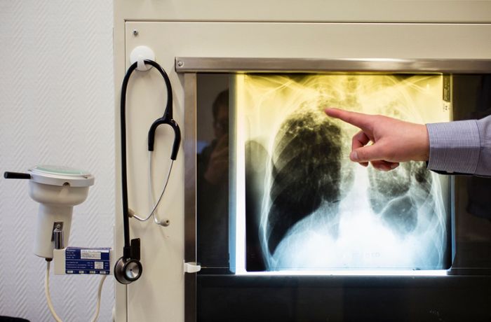 Welche Gefahr von Tuberkulose ausgeht