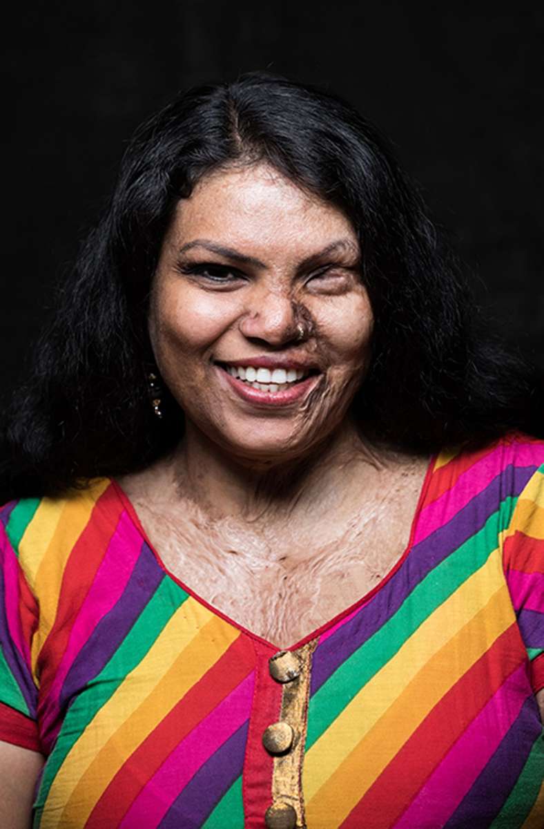 Mamta aus Indien hat von ihrem Mann Säure ins Gesicht geschüttet bekommen.