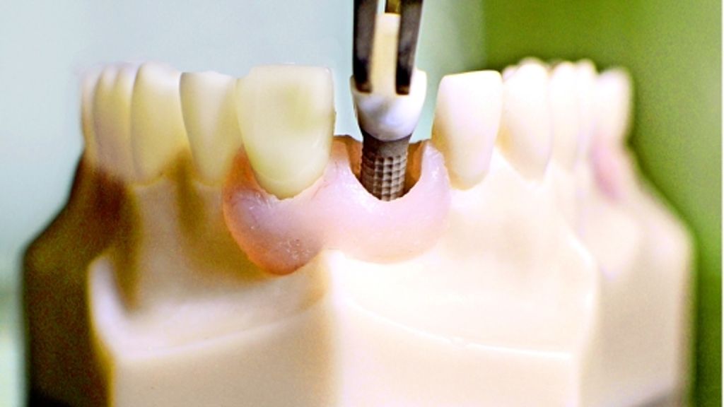 Zahnmedizin: Wie Zahnimplantate länger durchhalten