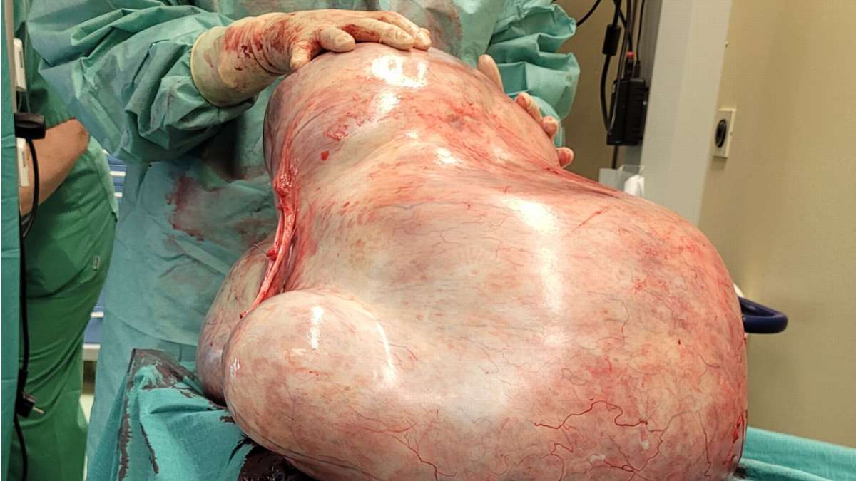 Magdeburg: Ärzte entfernen 32 Kilogramm schweren Tumor einer Frau