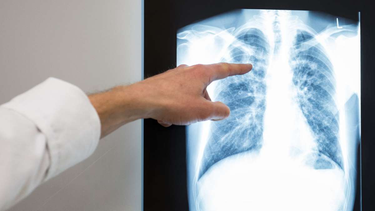 Fallzahlen: Tuberkulose-Fallzahlen in Deutschland leicht gestiegen