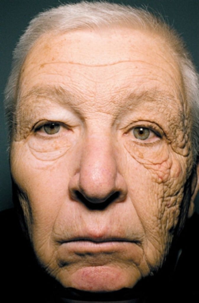Nach rund 30 Jahren als Lkw-Fahrer zeigt das Gesicht von William McElligott die Folgen der einseitigen Bestrahlung mit UV-Licht. Sonnencreme habe er nie verwendet, sagt der US-Amerikaner. Die Medizinerin Jennifer Gordon beschrieb den Fall von einseitiger Hautalterung in einem Fachmagazin.